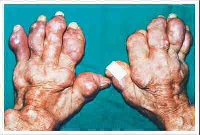 artrite gotosa tratamento